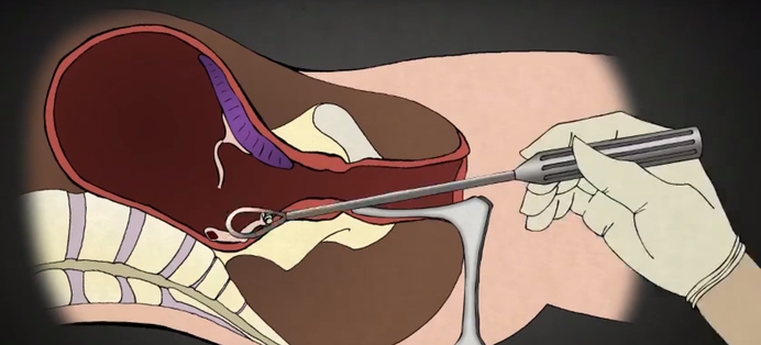 Gynaecoloog kritisch over meest gebruikte abortusmethode: tot 70% hogere kans op vroeggeboorte