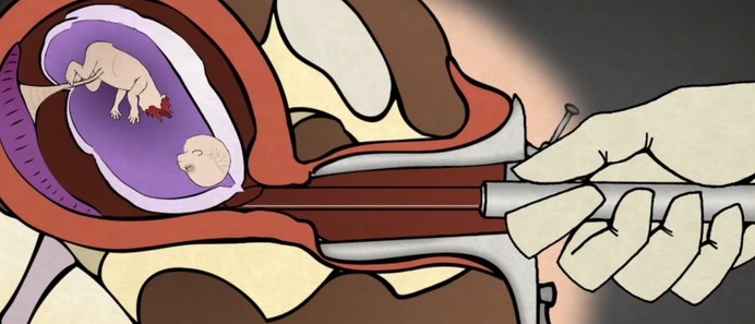 CU en SGP: Waarschuw bij abortus voor risico's curettage