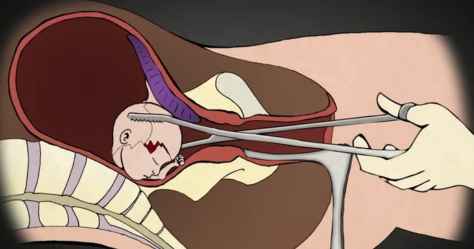 D66-winst zet de abortustang aan de schedel van nóg meer ongeboren kinderen