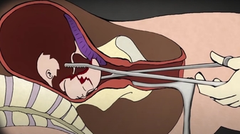 Abortus is een gruwelijke ingreep