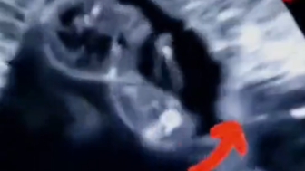 Schokkende beelden onthullen realiteit van abortus: ongeboren baby probeert te ontsnappen aan de dood