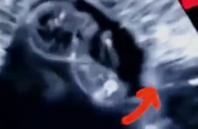 Schokkende beelden onthullen realiteit van abortus: ongeboren baby probeert te ontsnappen aan de dood