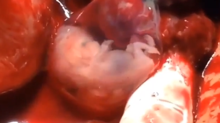 Dit filmpje toont de menselijkheid van een ongeboren kind van acht weken