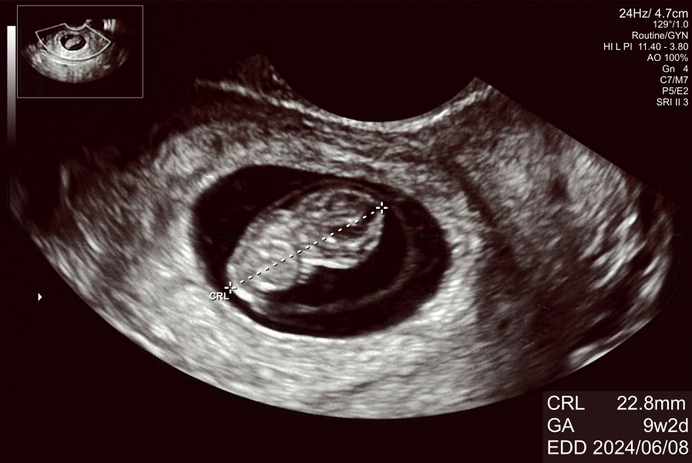 Een realistisch beeld van zwangerschap en abortus?